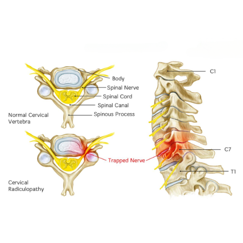 C Spine Pinched Nerve